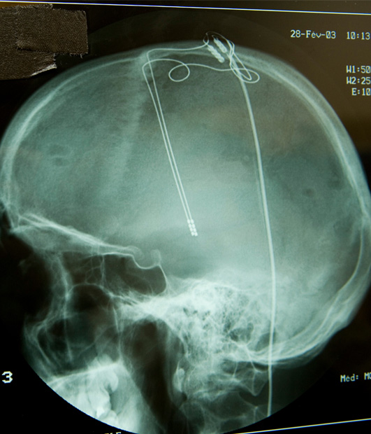 Leitlinien-Update: Invasive Parkinson-Therapie