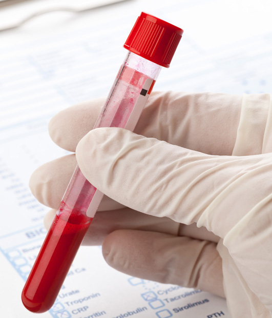 Erstmals Bluttest zur Parkinson-Früherkennung