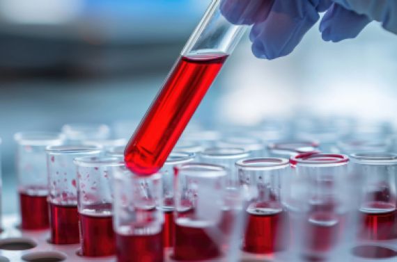 Neuer Bluttest: Parkinson-Früherkennung 7 Jahre vor Ausbruch