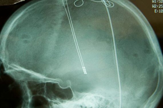 Leitlinien-Update: Invasive Parkinson-Therapie